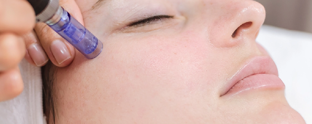 Microneedling