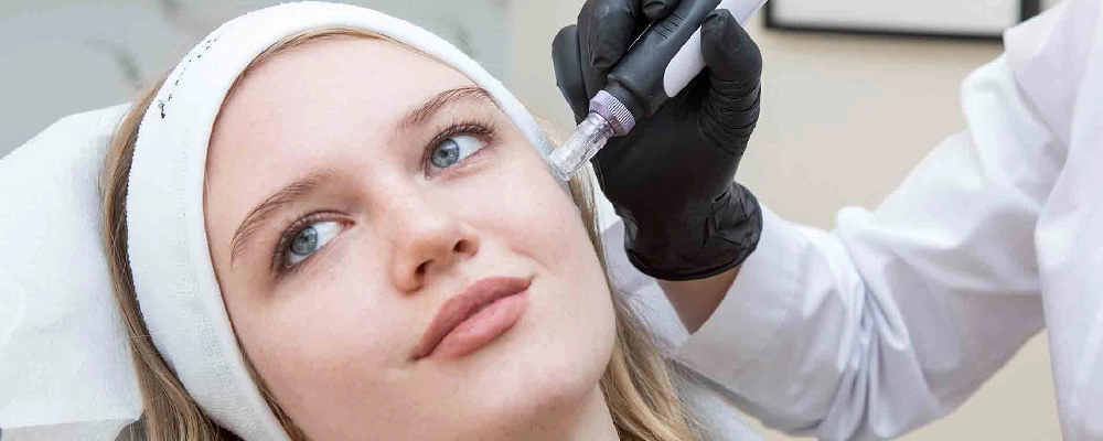 Microneedling